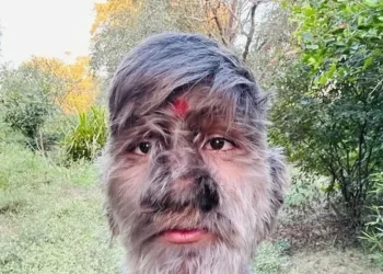 jovem-de-18-anos-bate-recorde-de-rosto-mais-peludo-do-mundo