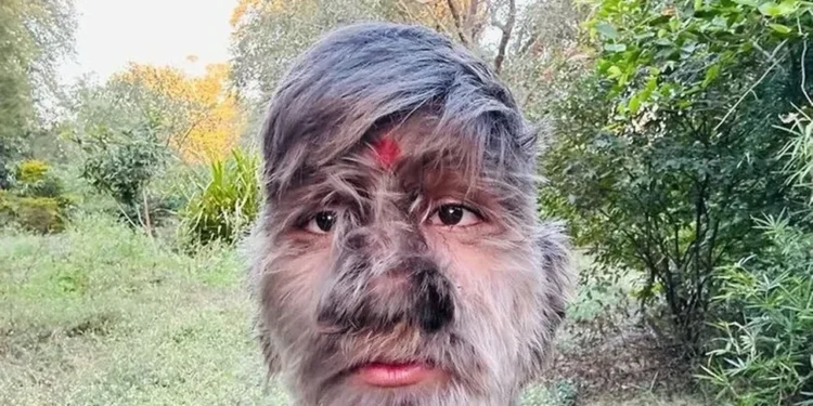 jovem-de-18-anos-bate-recorde-de-rosto-mais-peludo-do-mundo