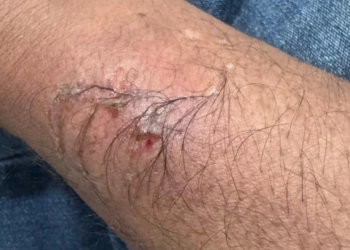 conselheiro-tutelar-e-mordido-por-crianca-na-regiao-noroeste-de-goiania