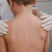 goias-reforca-luta-contra-meningite-apos-registrar-30-casos-da-doenca