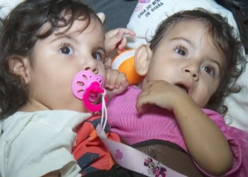 aruna,-gemea-siamesa-separada-da-irma-kiraz,-segue-em-estado-grave-em-goiania