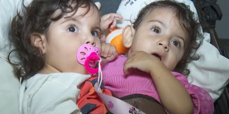 aruna,-gemea-siamesa-separada-da-irma-kiraz,-segue-em-estado-grave-em-goiania