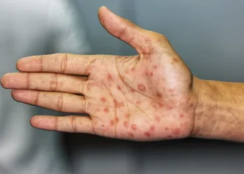 brasil-registra-aumento-preocupante-de-casos-de-sifilis-entre-homens