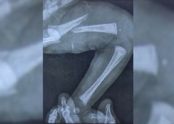 bebe-tem-femur-fraturado-durante-exame-do-pezinho-em-laboratorio-de-goias