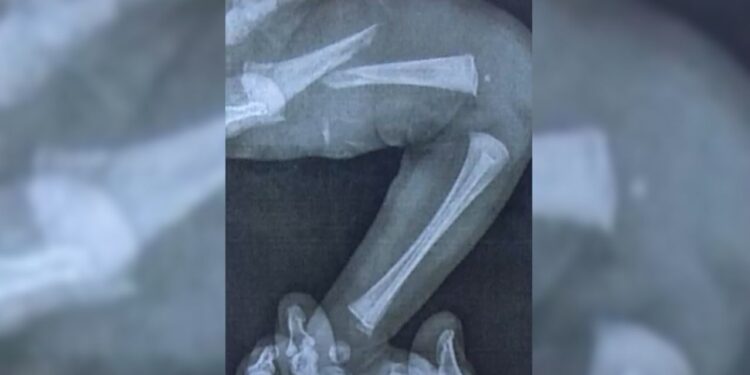 bebe-tem-femur-fraturado-durante-exame-do-pezinho-em-laboratorio-de-goias