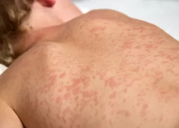 risco-de-surto-de-sarampo-mobiliza-goias-em-meio-ao-aumento-de-casos-no-pais