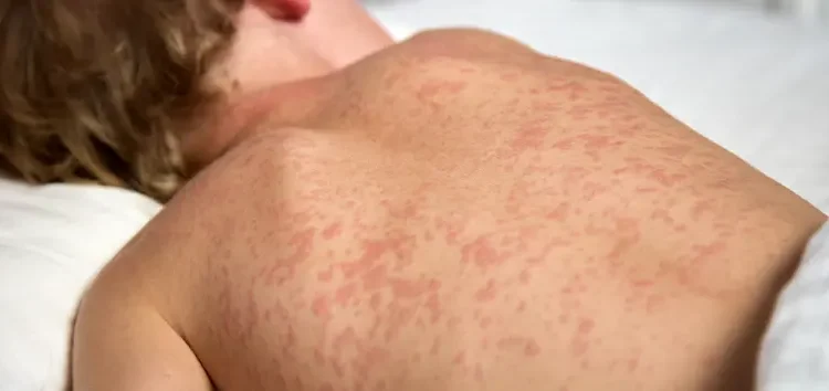 risco-de-surto-de-sarampo-mobiliza-goias-em-meio-ao-aumento-de-casos-no-pais