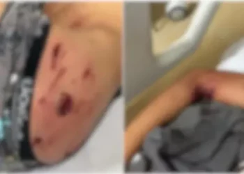 crianca-de-7-anos-e-atacada-por-pitbull-ao-buscar-pipa-em-casa-vizinha