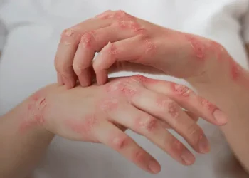ans-inclui-dois-medicamentos-para-lupus-na-cobertura-obrigatoria-dos-planos-de-saude