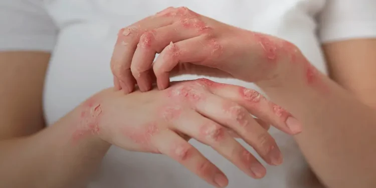 ans-inclui-dois-medicamentos-para-lupus-na-cobertura-obrigatoria-dos-planos-de-saude