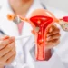 17-mil-novos-casos-de-cancer-de-colo-do-utero-surgem-anualmente-no-brasil