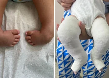 cirurgias-para-tratar-“pe-torto”-transformam-a-vida-de-criancas-em-aparecida-de-goiania
