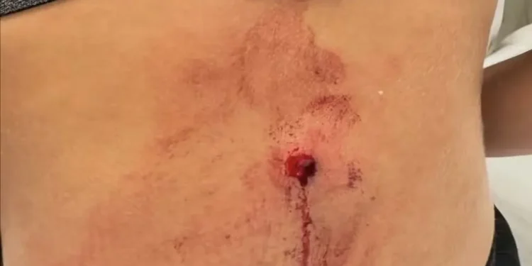 jogadora-do-tijuca-e-baleada-em-tentativa-de-assalto;-projetil-passou-a-1-mm-da-coluna