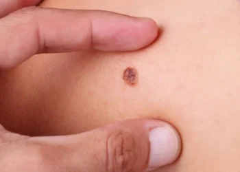 goiania-tera-mutirao-gratuito-de-cirurgias-para-cancer-de-pele