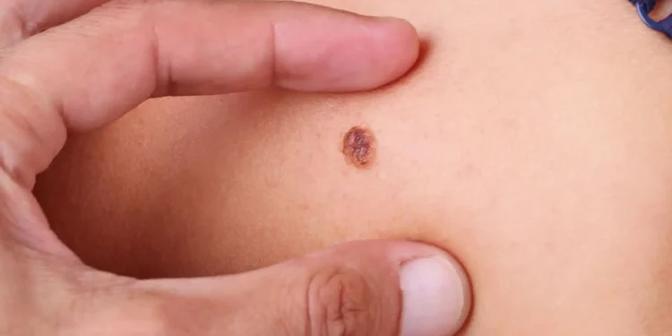 goiania-tera-mutirao-gratuito-de-cirurgias-para-cancer-de-pele