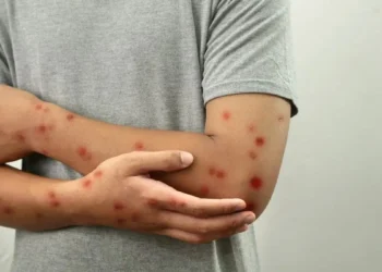 goias-investiga-cinco-casos-suspeitos-de-mpox