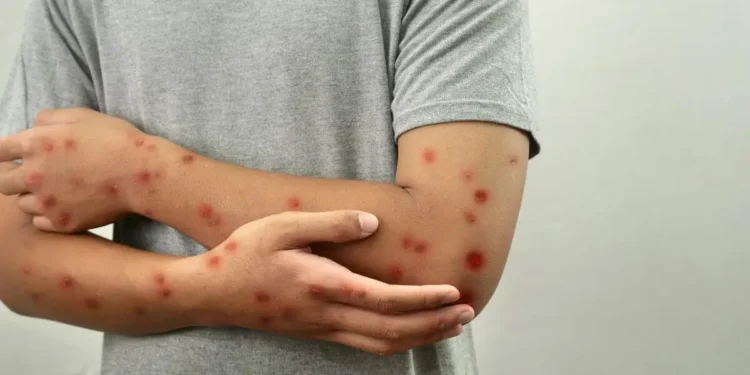 goias-investiga-cinco-casos-suspeitos-de-mpox