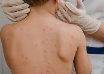 goias-registra-16-casos-e-6-mortes-por-meningite-em-2026