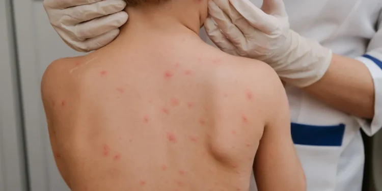 goias-registra-16-casos-e-6-mortes-por-meningite-em-2026