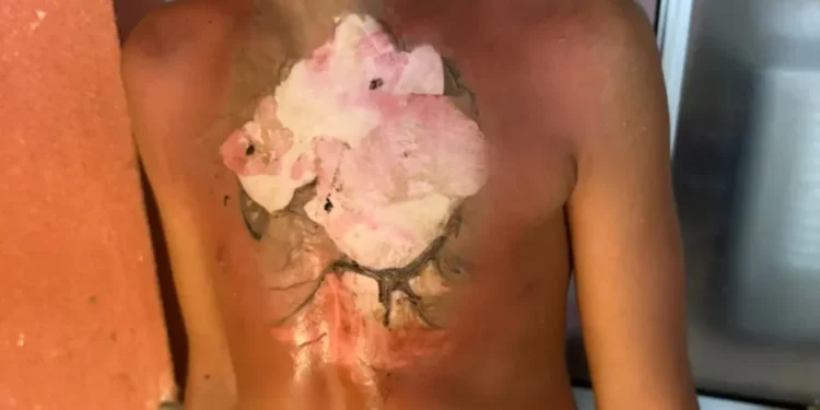 adolescente-queimado-em-condominio-de-goiania-passa-por-cirurgia-e-segue-sob-cuidados-medicos