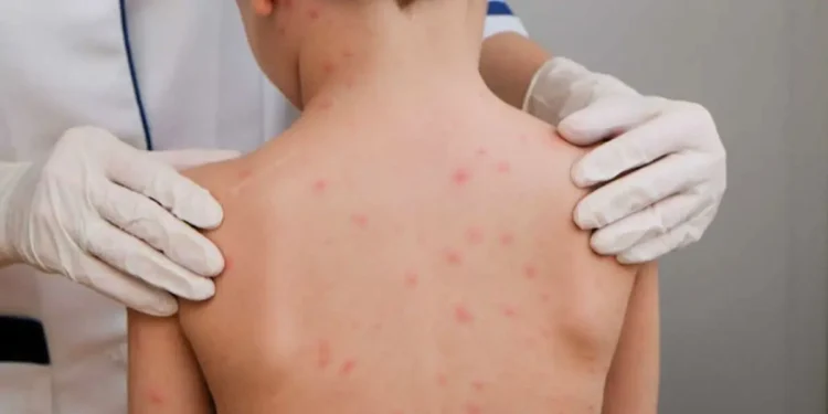 goias-registra-232-casos-de-meningite-em-2025-e-11-mortes-em-2026