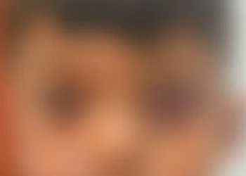 tulio-isac-filho-denuncia-que-filho-teve-rosto-queimado-com-cigarro-e-olho-roxo